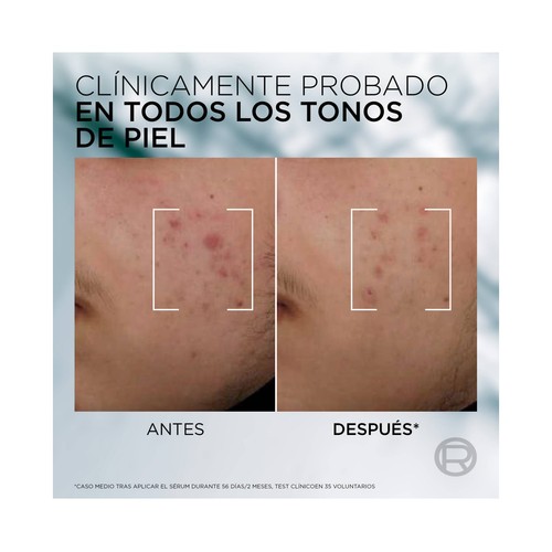 L´ORÉAL PARIS Men expert derma control Sérum eliminador de manchas y marcas post acné 30 ml.