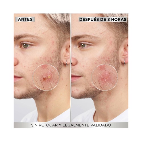 GARNIER Pure active Parches anti-granos (10 y 12 mm) invisibles 8 horas 22 uds.